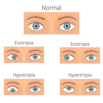 Esotropia - Everyday Sight